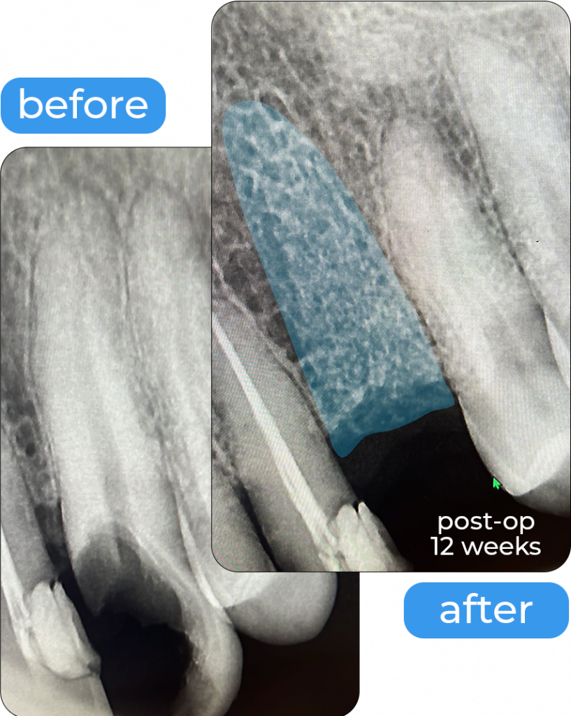 Before and after radiographs of a grafted extraction socket, 12 weeks post-op